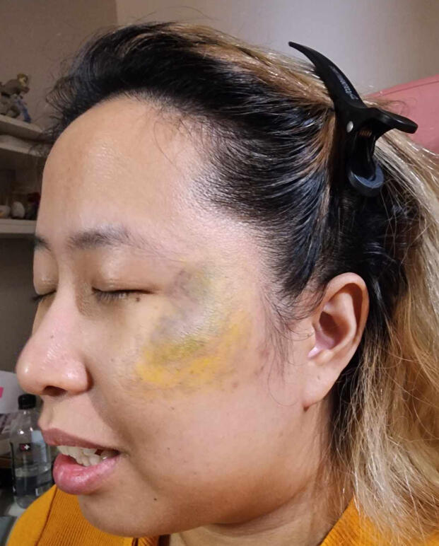 Healing Bruise